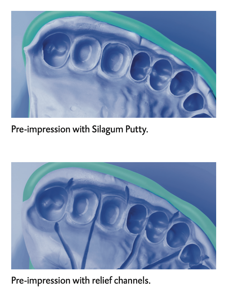 Cao su đặc trộn tay Silagum Putty DMG Đức